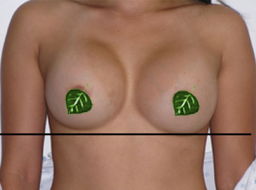 Breast Reconstruction