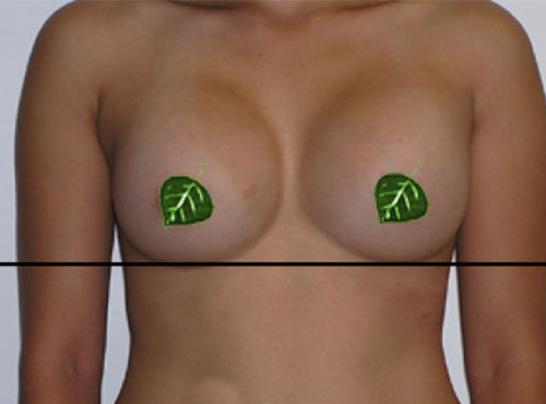 Breast Reconstruction