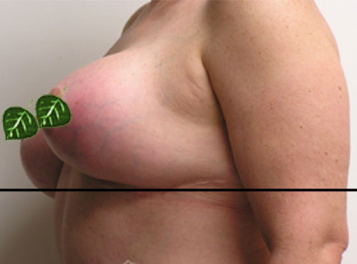 Breast Reconstruction