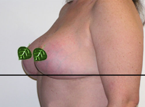 Breast Reconstruction