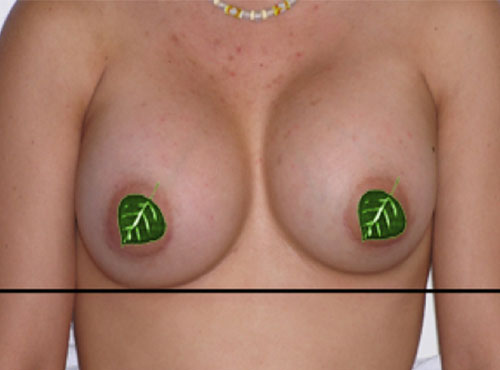 Breast Reconstruction