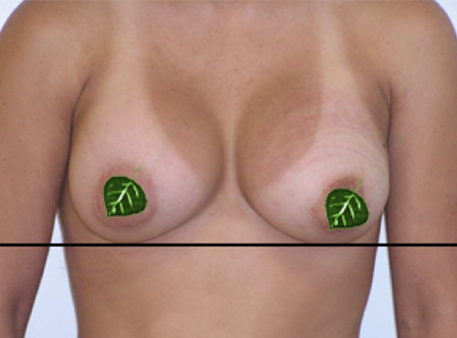 Breast Reconstruction