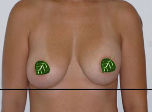 Breast Reconstruction