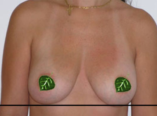 Breast Reconstruction