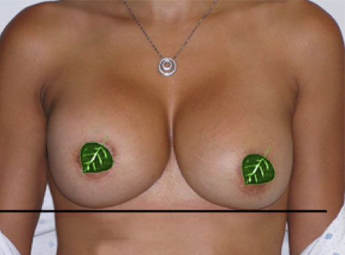 Breast Reconstruction