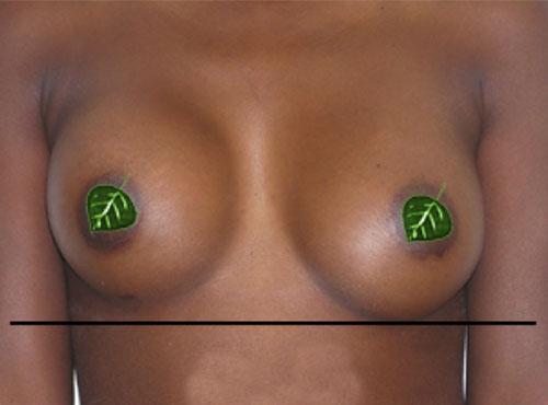 Breast Reconstruction