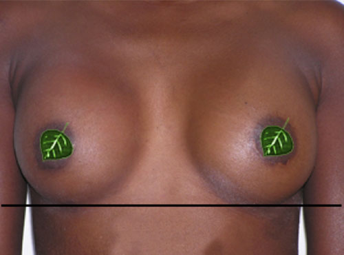 Breast Reconstruction