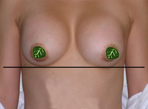 Breast Reconstruction