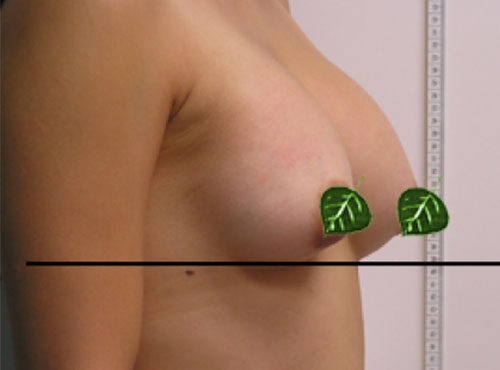 Breast Reconstruction