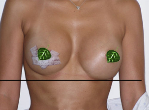 Breast Reconstruction