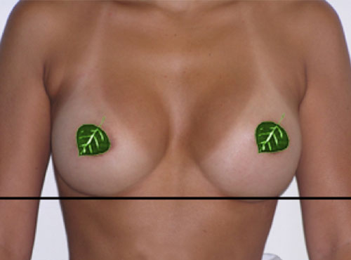 Breast Reconstruction