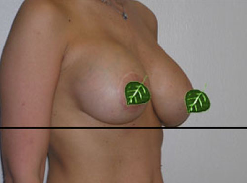 Breast Reconstruction