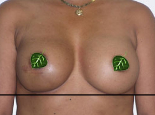 Breast Reconstruction