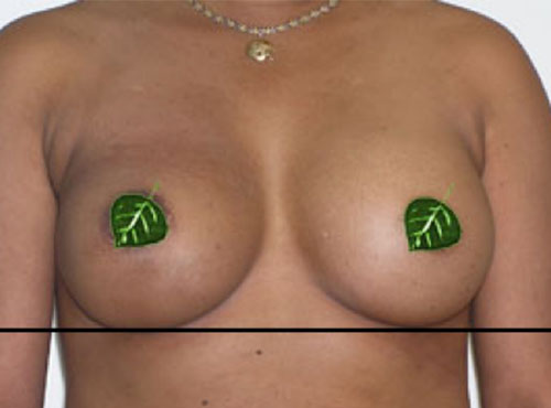 Breast Reconstruction